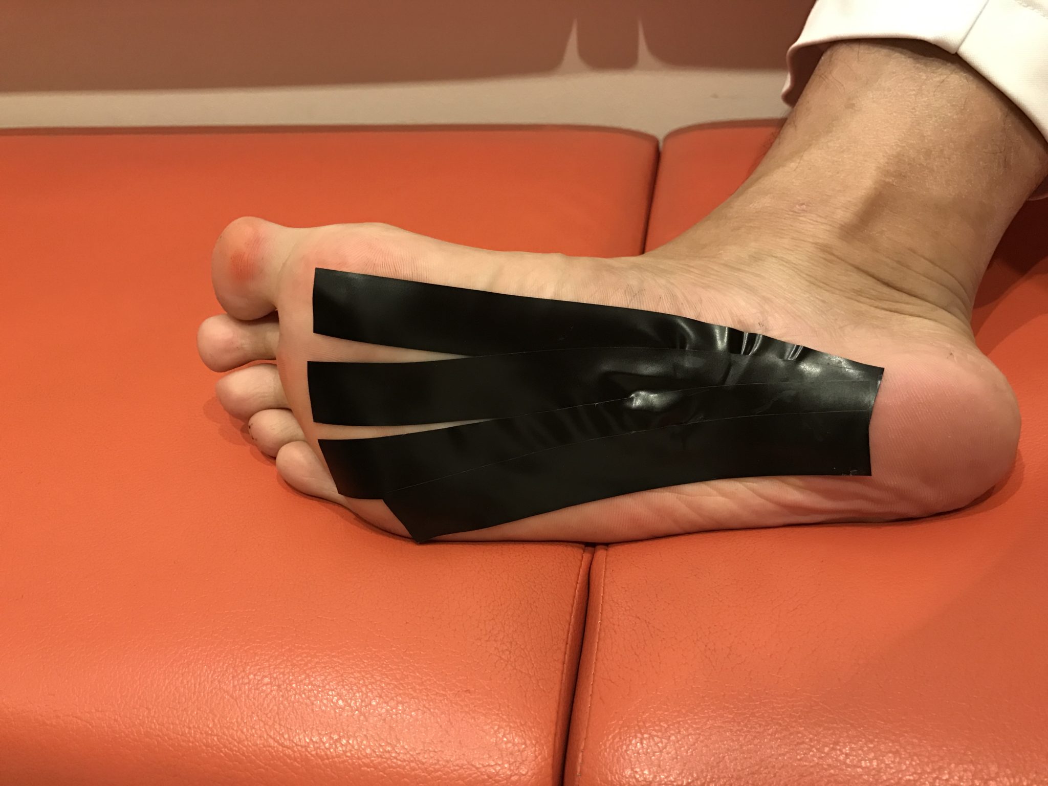 足底腱膜炎,イメージ